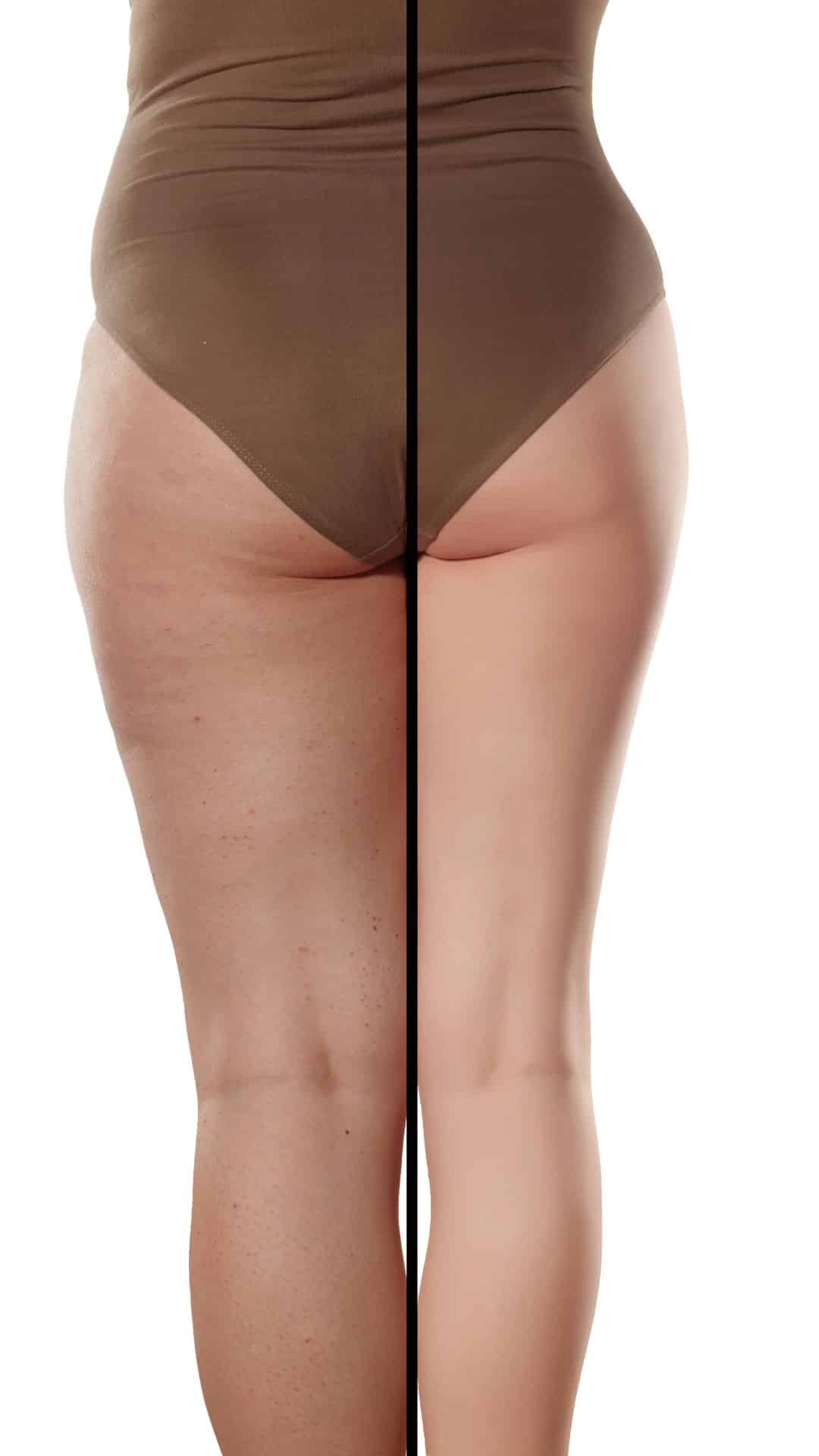 comparison of female legs with and without cellulite and fat